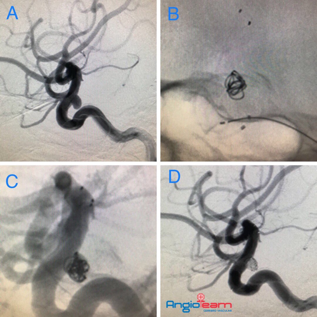 Angio_team's tweet photo. #AngioteamCase
A 57-year-old, woman with HBP and headache, MRI showed unruptured brain aneurysm. Endovascular treatment whith stent and coils. Procedure time 45 minutes, no complications, patient evolution was satisfactory, next day discharge. π https://t.co/4EFTRm94ru https://t.co/fQNm3k5376