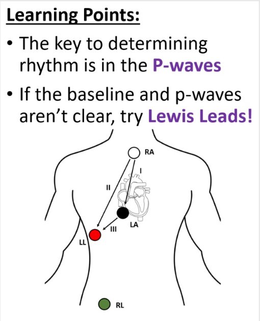 COREIMpodcast's tweet photo. #FOAMed #pwaves #LewisLeads https://t.co/pph16JI3qK