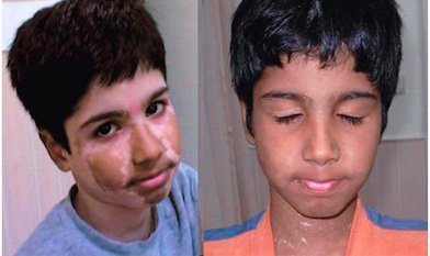 PharosLaser's tweet image. If you have #vitligo, but #OwnYourBeauty, perhaps you’re like @CoverGirl @theamydeanna + wouldn’t change your face for the world. Great! But perhaps you’d like to know if #repigmentation is an option for you, request #Pharos info to send to your Dr.: goo.gl/qT9Ln2