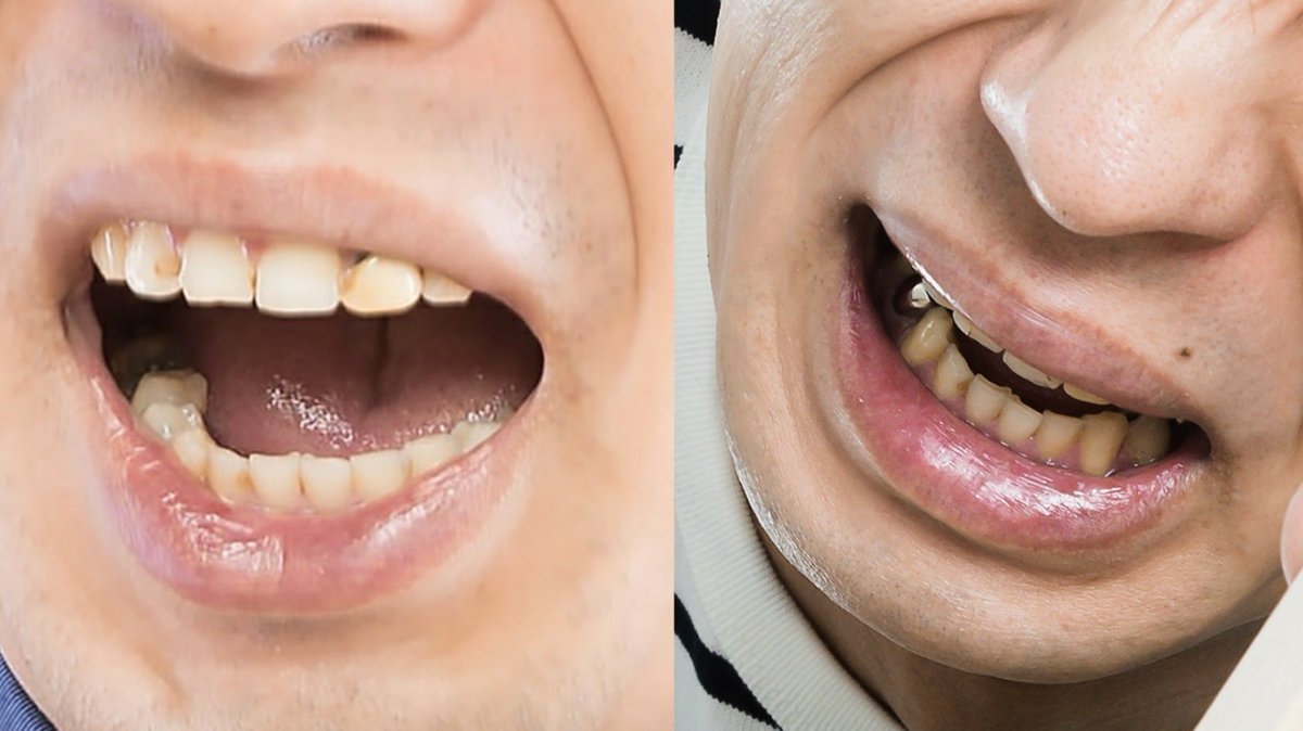 虫研 Cavities Labo 有名人の歯 Vol 11 大川竜弥 フリー素材 Ryumagazine 虫歯 銀歯状況 左上1レジン 2差し歯 5 6クラウン 4インレー 右上1 2レジン 6クラウン 右下5クラウン 当初なし 見える範囲であり 実際はもっと多いと推測 大川