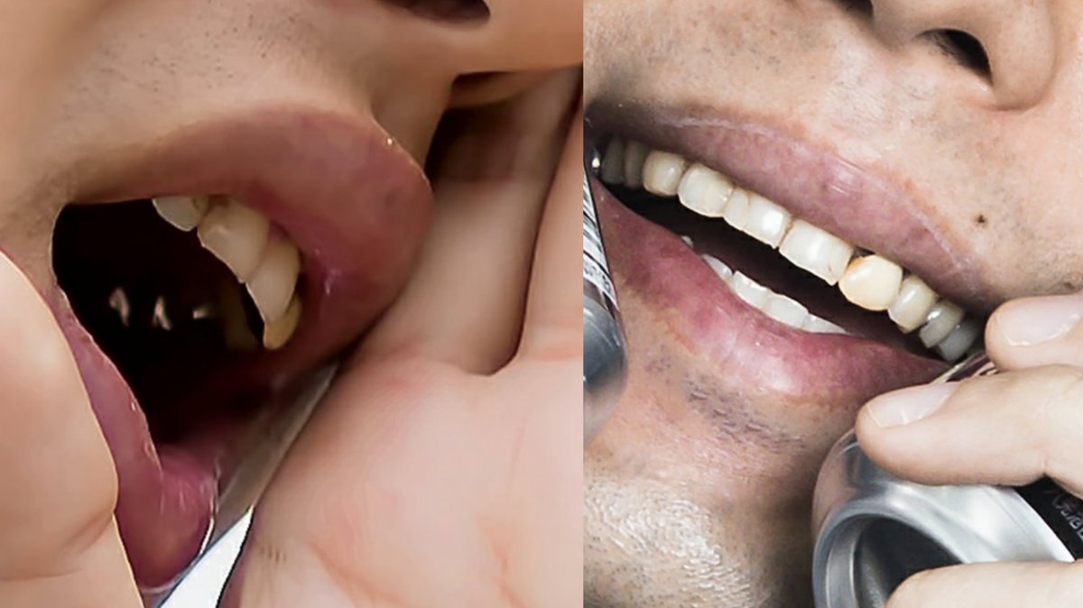 虫研 虫歯研究所 有名人の歯 Vol 11 大川竜弥 フリー素材 Ryumagazine 虫歯 銀歯状況 左上1レジン 2差し歯 5 6クラウン 4インレー 右上1 2レジン 6クラウン 右下5クラウン 当初なし 見える範囲であり 実際はもっと多いと推測 大川竜弥