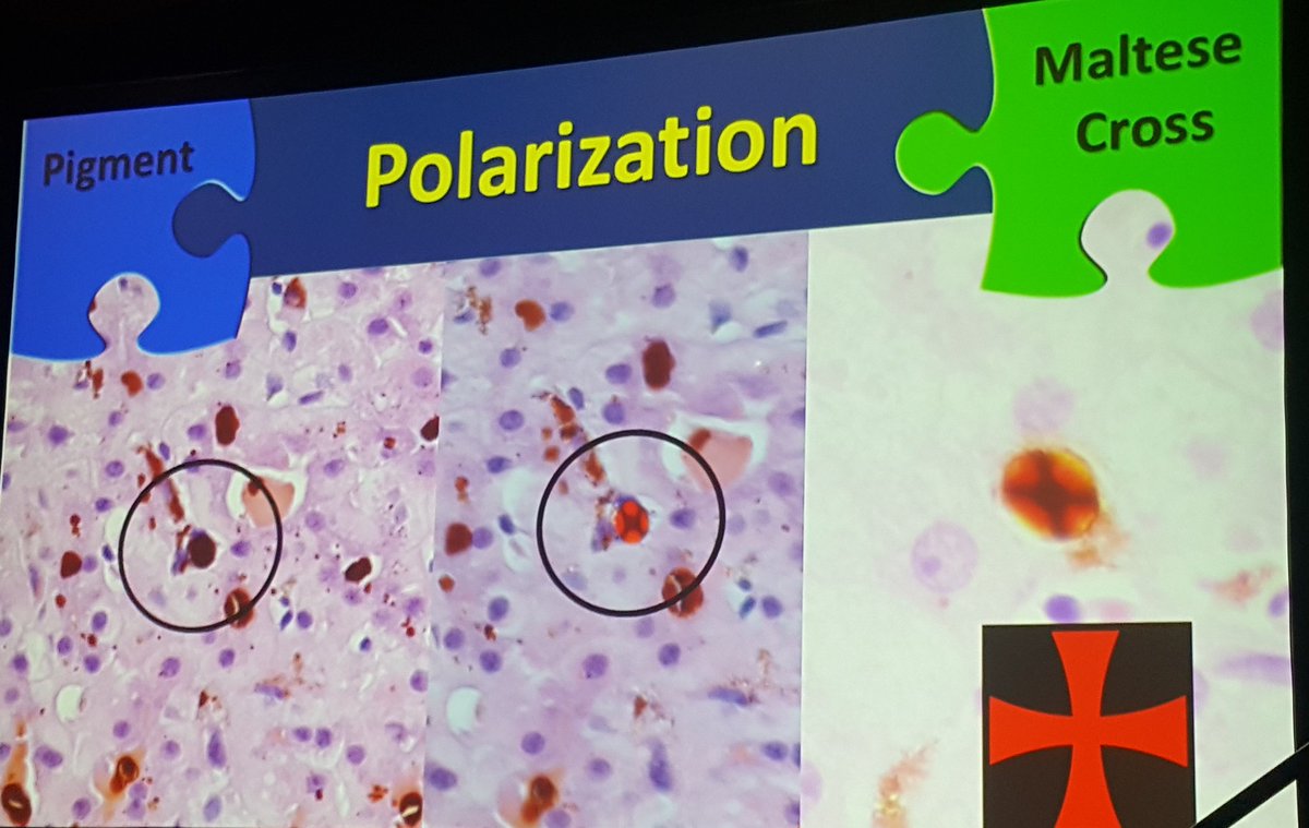 Maria Westerhoff from U Mich at Liver evening specialty conference: great case of porphyria <a href="/LiverPath_HPHS/">Hans Popper Hepatopathology Society</a> <a href="/TheUSCAP/">USCAP</a>