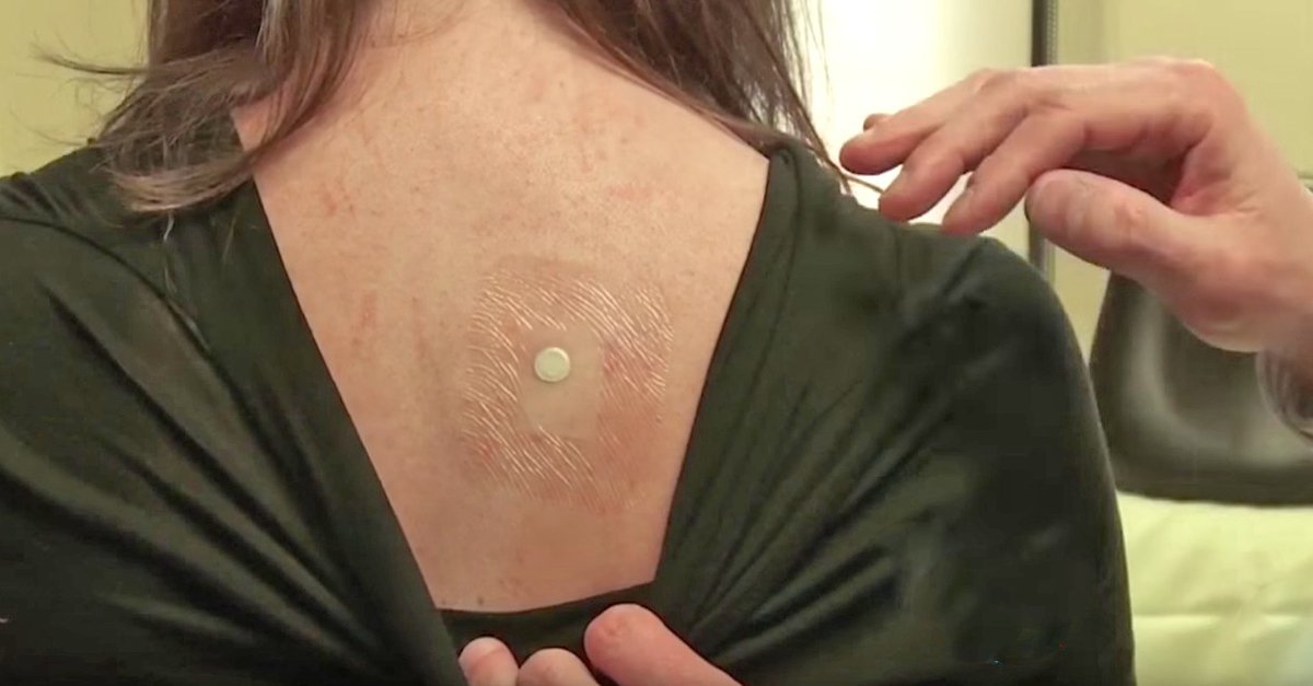 ViajandoWaldo's tweet image. Le pusieron una batería de reloj en la espalda. Mira lo que ocurre cuando la despegan bit.ly/2hpT8wQ