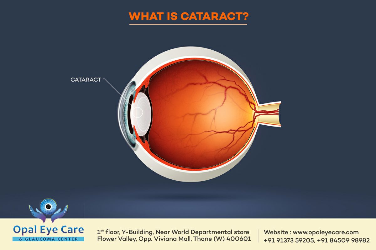 A #cataract is a dense, cloudy area that forms in the lens of the eye. A cataract begins when proteins in the eye form clumps that prevent the lens from sending clear images to the retina. 

For more details on cataract treatment & surgery visit opaleyecare.com