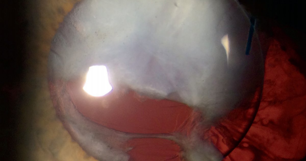 aao_ophth's tweet photo. Check out EyeNet's March feature on cataract complications. What would you do in these challenging cases? [AAO Members] #cataract #ophthalmology https://t.co/PCkyjaHuQM https://t.co/xSHGtQV1ys