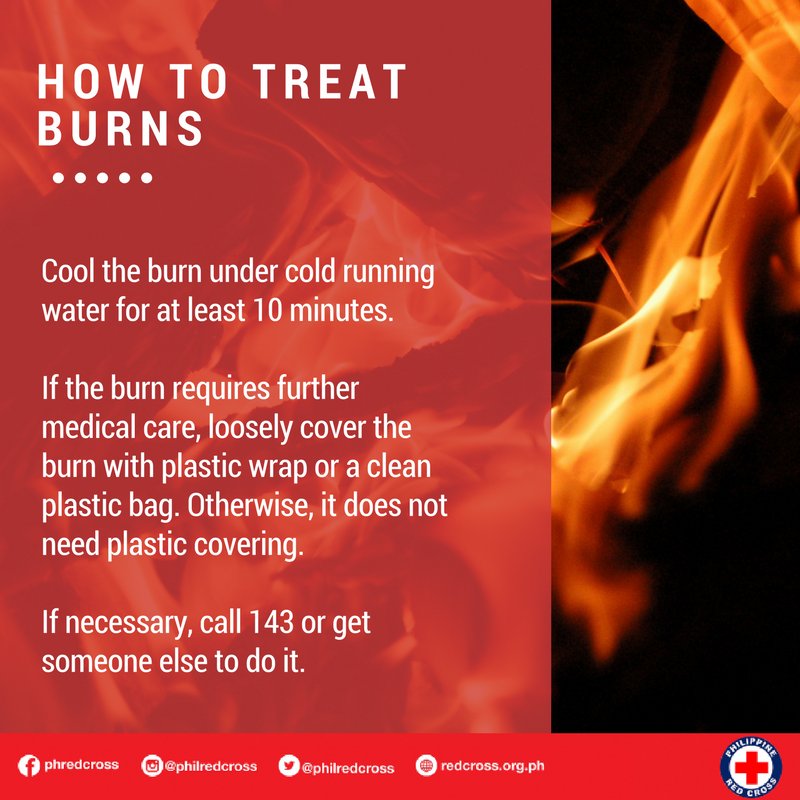 philredcross's tweet photo. Here's all you need to know on how to treat minor burns.

To learn more first aid tips, download the First Aid App on Play Store or App Store. 

#aPula #FirePreventionMonth https://t.co/huticAfK25
