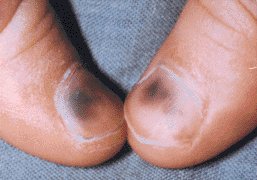 Subungual haemorrhage in hydroa vacciniforme (HV)
onlinelibrary.wiley.com/doi/10.1046/j.…
HV is usually sporadic and presents in childhood, with the majority improving during adolescence or early adulthood. It is characterized by blistering of sun-exposed sites that crust and heal with scarring