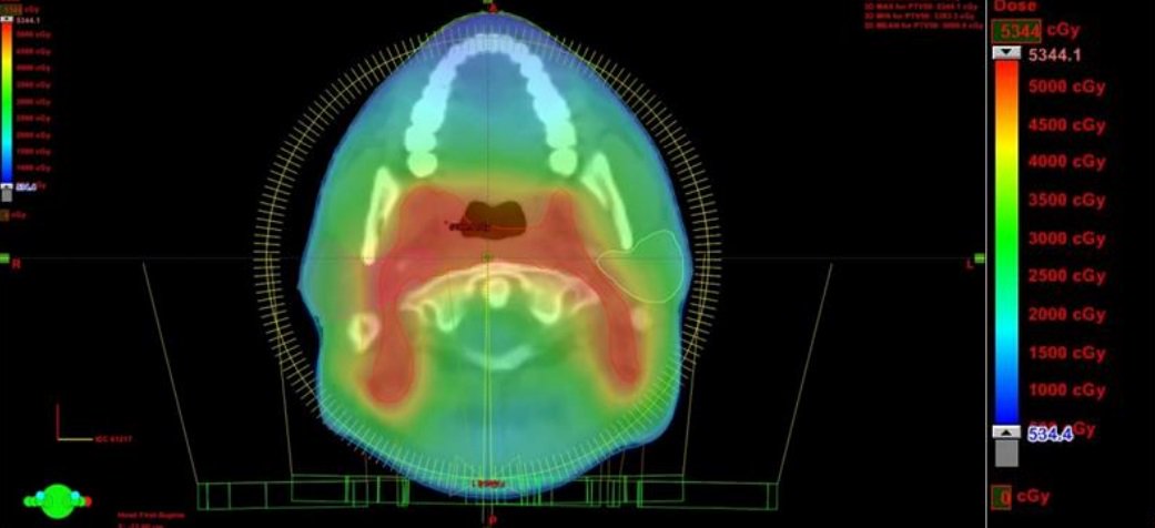 archclincases's tweet photo. Comparative evaluation of the doses received by the parotid glands as predictors of xerostomia be 3D-CRT, IMRT and VMAT irradiation techniques in local advanced nasopharynx cancer 
https://t.co/r64BzGPte9 https://t.co/A9lH8hvIKQ