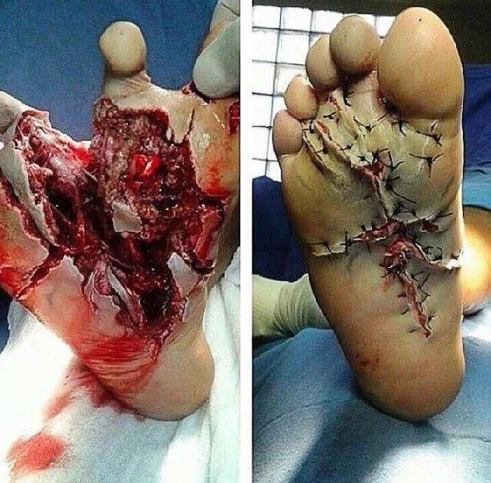 rawleak_'s tweet photo. [NSFW] Reconstruction of a minced foot. https://t.co/jB6Pw6WNJD