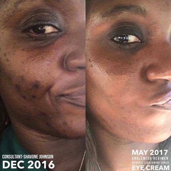 Rodanrodannadan's tweet photo. It's time to stop bitchin about ACNE and start working on a solution!!
Unblemish is the #1 premium acne brand in the US backed by a 60 day money back guarantee! 
Order a regimen today or tomorrow and get a free Lash Boost ($150 value)
#skin #skincare #beauty #makeup #zits https://t.co/AE8g4r0NOs