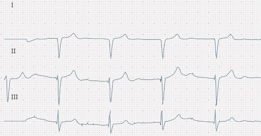 ecgbuddy's tweet photo. What’s this patient’s heart axis?

#ECG #ecgbuddy #studybuddy #doctopia #ecg #ecginterpretation #ecgreading #ecgcourse #emergencyroom #hospitallife #medicalstudent #medschool #medicallife #ERlife #doctorslife https://t.co/YJP2hlNVhE