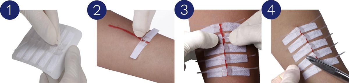 DermaClip's tweet image. Used for over 10,000 of skin closure procedures in a small time period with 100% success, DermaClip® provides the perfect alternative to traditional painful #wound_closure_methods!dermaclipus.com