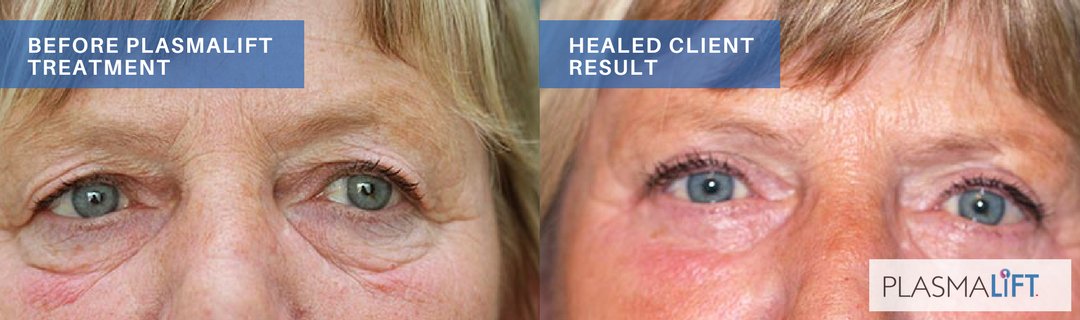 plasmaliftca's tweet photo. Awesome before and after treatment images. Want to learn more about Plasmalift Plasma Soft Surgery? Send us a message or contact us at 1.866.330.9490 for info. Check also our website at https://t.co/pbxDTRvlpY  today. #plasmalift #plasmasoftsurgerycanada #plasmasofttraining https://t.co/7kh9RajKBS