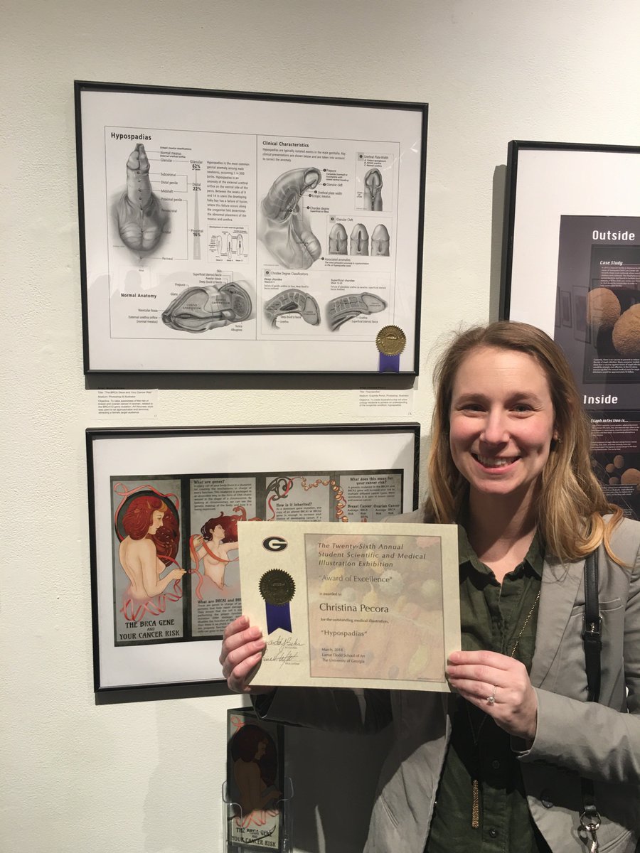 Congratulations, Christina Pecora (CO 2018), on receiving an Award of Excellence for her surgical iIllustration series, “Hypospadias,” at the 26th Annual UGA/AU Scientific and Medical Illustration Exhibit.  #medart <a href="/AUG_University/">Augusta University</a>