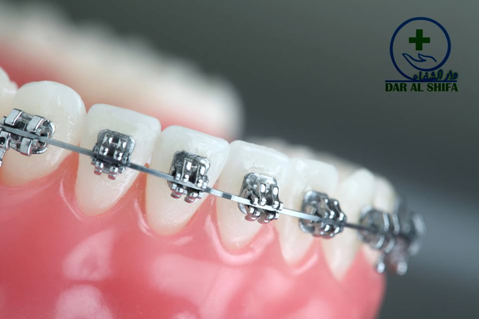dar_center's tweet photo. *Get a pretty Smile now*
With Dr. Erum Behroz (Consultant Orthodontist)

All types of Braces &amp; Aligner treatment (Clear, Metal, Ceramic, Lingual, Invisible &amp; More)

Book your appointment now:
Inbox 📩 or call ☎ 021-35171191
https://t.co/jKb0aeCUcI

#barces #dentalcare #dental https://t.co/RlrSX8odgW