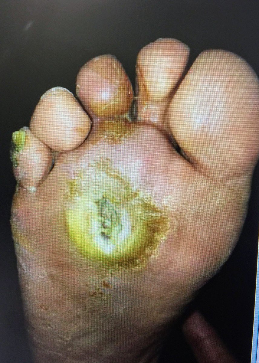 SOBE_Vascular's tweet image. 62 y/o F DM (HgA1c 14), plantar foot wound, OM of met head RC6 #CLI. #CSI @AbbottGlobal #commandwire #asahiregalia #POBA #Stopthechop #CLIfighters @Mustapja @FadiSaab17 @drsavealimb @SriniTummala @BOlivieriMD @DrBTKatzen @DrBobBeasley @keithppereira @kmadass @SDhandMD @JVIRmedia