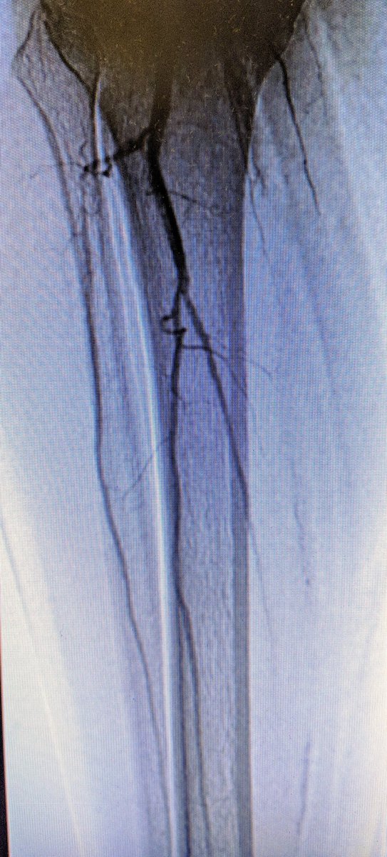 SOBE_Vascular's tweet image. 62 y/o F DM (HgA1c 14), plantar foot wound, OM of met head RC6 #CLI. #CSI @AbbottGlobal #commandwire #asahiregalia #POBA #Stopthechop #CLIfighters @Mustapja @FadiSaab17 @drsavealimb @SriniTummala @BOlivieriMD @DrBTKatzen @DrBobBeasley @keithppereira @kmadass @SDhandMD @JVIRmedia