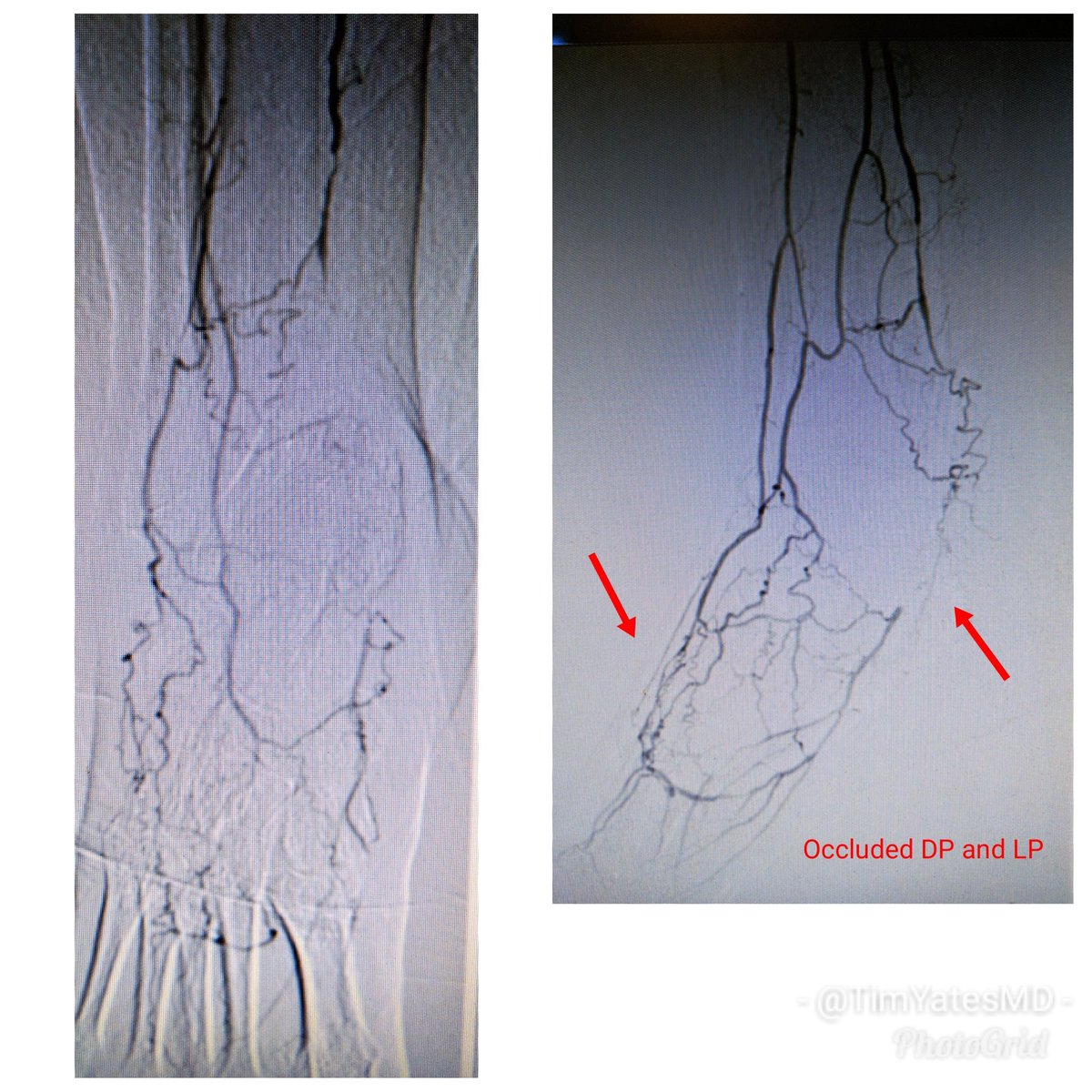SOBE_Vascular's tweet image. 62 y/o F DM (HgA1c 14), plantar foot wound, OM of met head RC6 #CLI. #CSI @AbbottGlobal #commandwire #asahiregalia #POBA #Stopthechop #CLIfighters @Mustapja @FadiSaab17 @drsavealimb @SriniTummala @BOlivieriMD @DrBTKatzen @DrBobBeasley @keithppereira @kmadass @SDhandMD @JVIRmedia