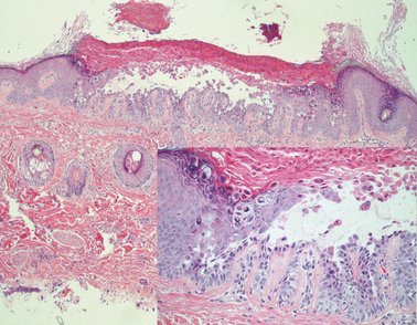 Pityriasis Amiantacea as the sole manifestation of Darier's disease (DD)
onlinelibrary.wiley.com/doi/10.1111/j.…
Only a handful of cases of localised DD of the scalp have been reported and all of these have been in adults, unlike in this case.