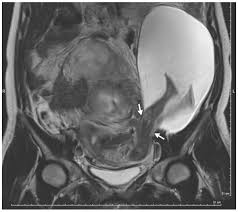 101Residency's tweet photo. The following have all been associated with the following seen below except?
A. Prior Invasive Molar Pregnancy
B. Significant Myomectomy
C. Excessive uterine Stimulation
D. Use of DES during Pregnancy
E. History of placenta percreta or increta https://t.co/2VYijcECqw