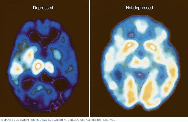 Ada jauh beza Depression dengan sedih. Setakat sedih, itu emosi biasa manusia. Semua orang ada. Tapi Clinical Depression, dia effect sampai otak. Hormon jadi tak balance, saiz certain part otak mengecut dll. They LITERALLY not able to be happy. Tengok gambar.