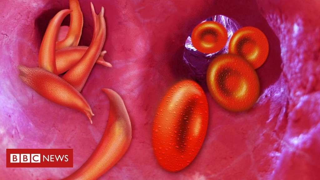 Tracing sickle #Cell back to one #Child, 7,300 years ago: mambolook.com/link/16184149, mambolook.com/africa, duniayote.com/africa