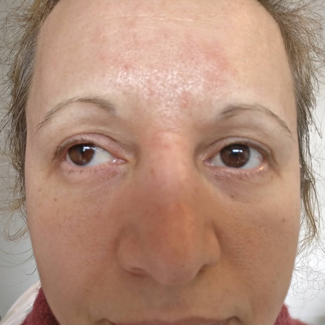 MBmicroblading's tweet photo. Brow transformation #microblading #london #essex #semipermanentmakeup #bblogger #eyebrows,, #hairstrokes #hairloss https://t.co/M5NPnueesl