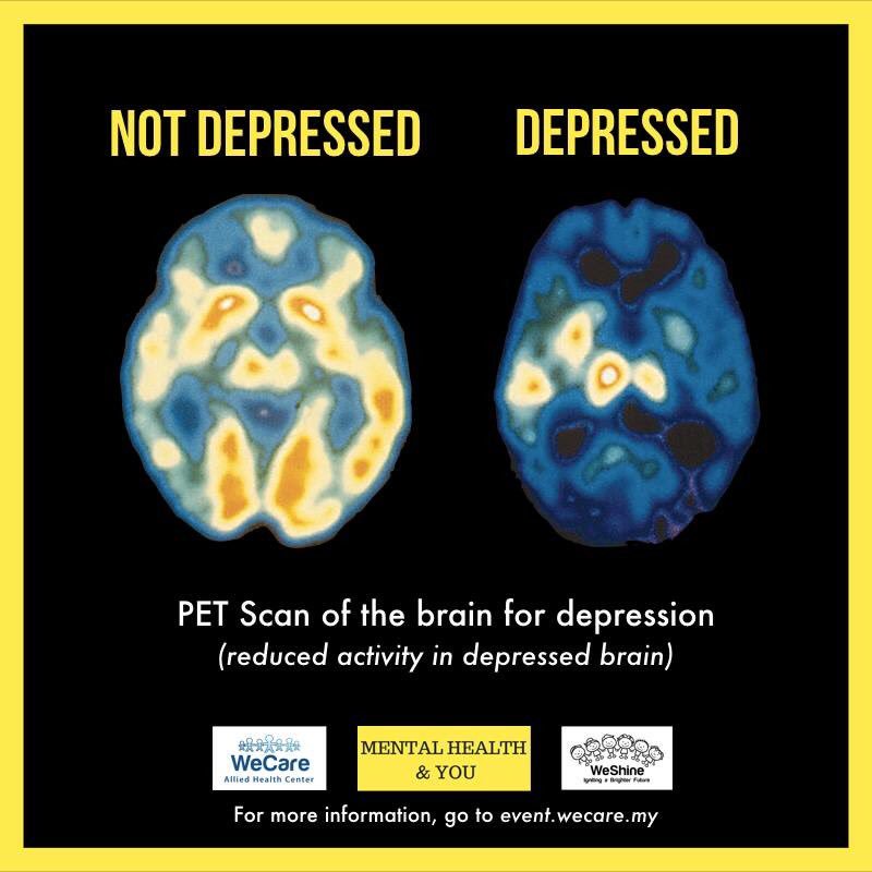 Take a look of how different it is the brain of someone who has depression with someone who isn’t.The depressed brain activity reduced significantly, making them unable to be happy or to enjoy simple thing in our life.