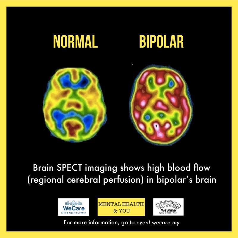 Bipolar is a disorder when someone has two extreme mood.Too happy (mania) or too sad (depress). Living with this is a nightmare. It’s tiring and really affect one’s everyday life.Their brain shows overflow of blood (red) and really low (yellow) making their moods extreme.