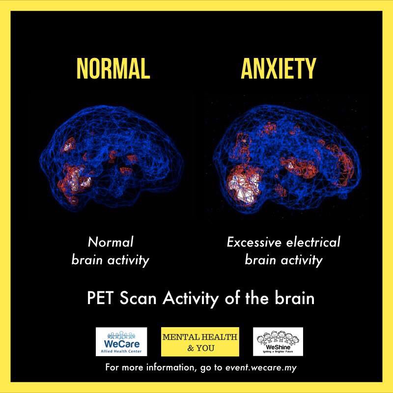 Now look at someone who has Anxiety Disorder.Their electrical brain activity goes haywire and over active, making them to be overthink, anxious, over concern to the point them everything feels overwhelmed.