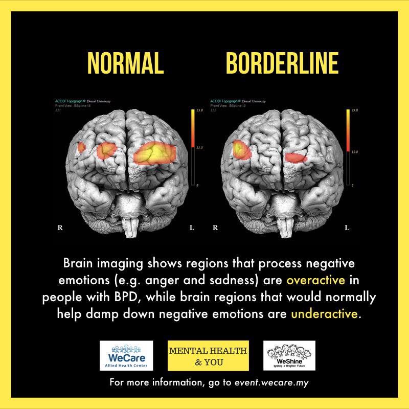 Borderline Personality Disorder (BPD) is really scary. The brain that process negative emotion (anger or sadness) are so active that a simple sad feeling feels like the world coming to end.BPD affect someone’s emotion really hard that this usually affect their relationship.