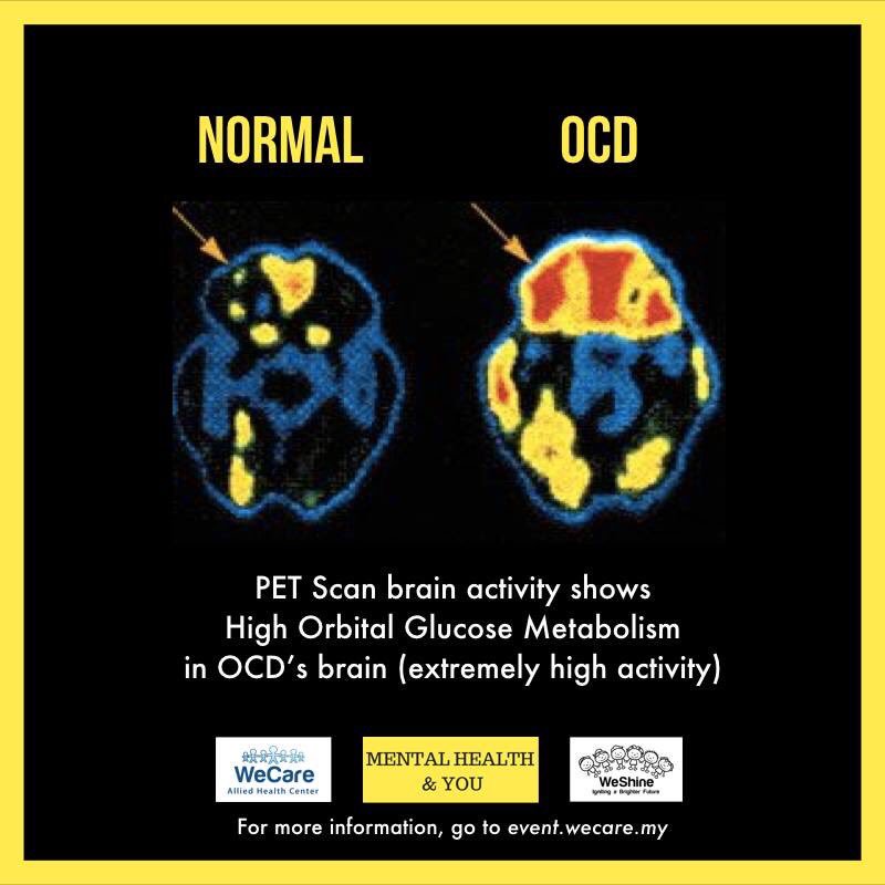 You’ve heard OCD right? One of the most overused mental disorder.Suka susun barang dah kata OCD.Tak boleh tengok senget dah mengaku OCD.Itu namanya perfectionist.OCD ni lagi teruk tau. Sampai orang tu akan berulang-ulang buat benda tu. Kalau tak buat, dia raasa stress gila