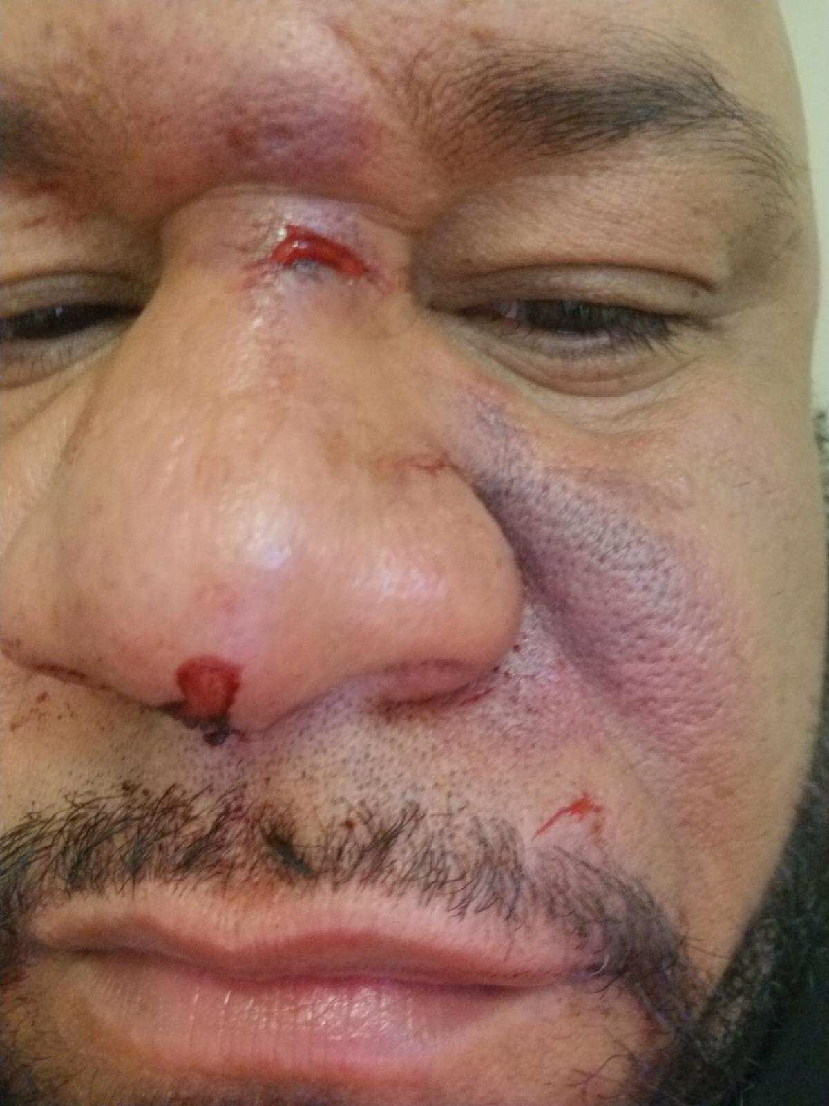 broken nose close up