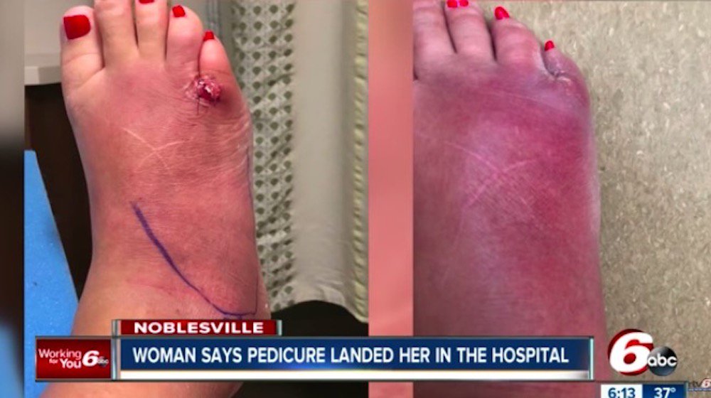 WomensHealthMag's tweet photo. This woman's foot looks totally gruesome after a horrifying pedicure gone wrong: https://t.co/F6fV2JTi3A https://t.co/sQCxTEzl9f