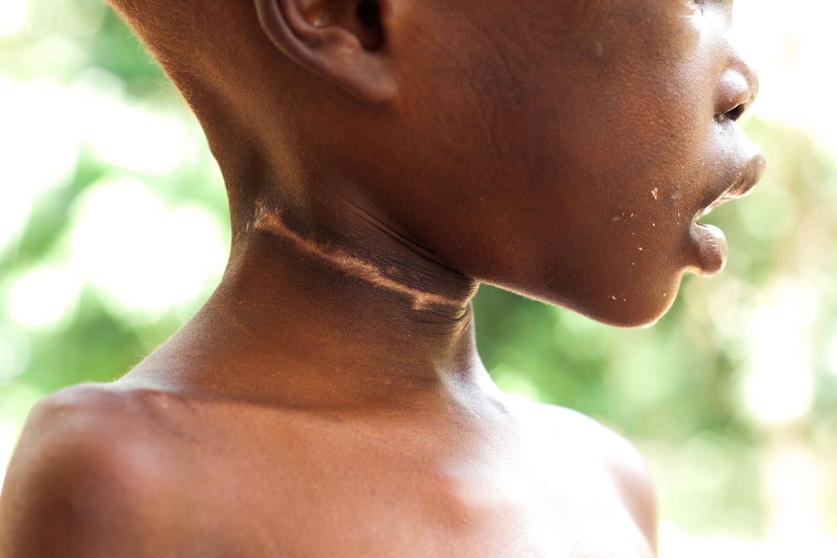 NoahsArkUganda's tweet photo. "I wondered what this boy possibly could have done do deserve this kind of treatment by his grandmother" our social worker wrote in her report about Shawn. Shawn is safe now. To be continued. https://t.co/xs4jseBqtM