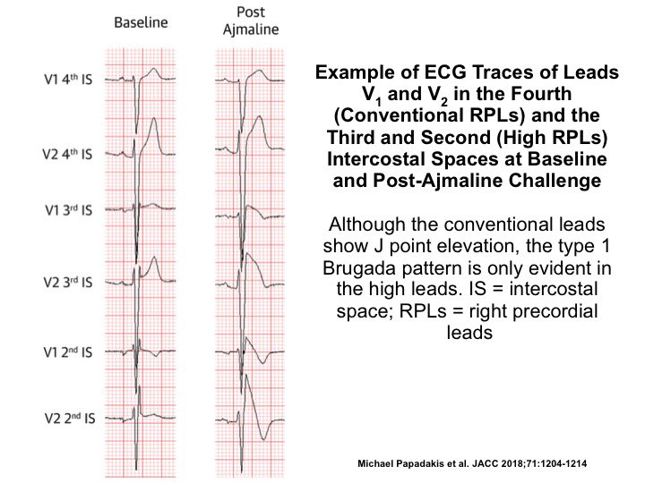 Figure showing the importance of high right precordial ECG leads for the diagnosis of type 1 Brugada pattern after Ajmaline challenge #JACC