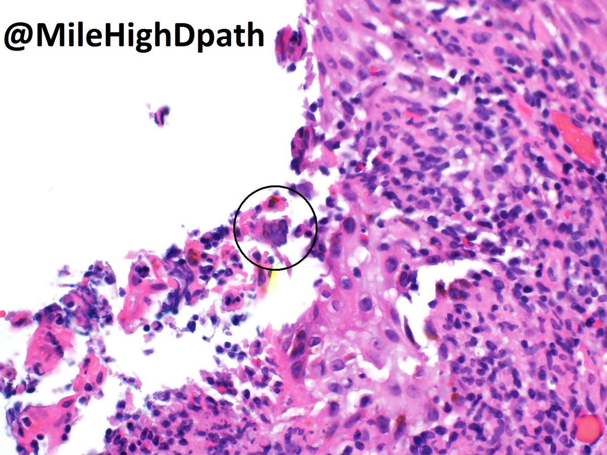 MileHighDpath's tweet photo. Continuing a multipart series (hosted personally by me) on "Better Lucky Than Good,"😃-- do you see the teensy tiny feature at the extreme lat edge of just one half of a bisected punch from the forehead of a 59 y/o man.  What do you think of this finding? #Dermpath #Luckythangood https://t.co/zpHOE2rtFV