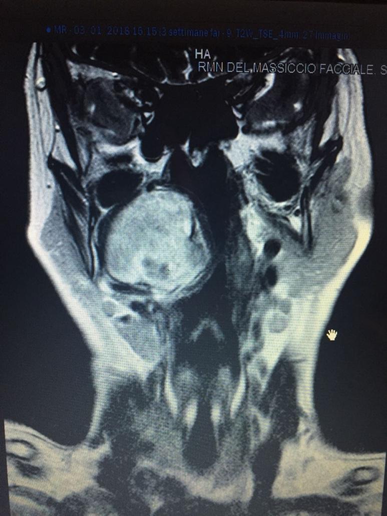 ospedalesancarl's tweet photo. Operato con successo a Villa d'Agri un raro tumore neurologico del massiccio facciale https://t.co/2Eantcqn55 https://t.co/OQbQR0ZDDh