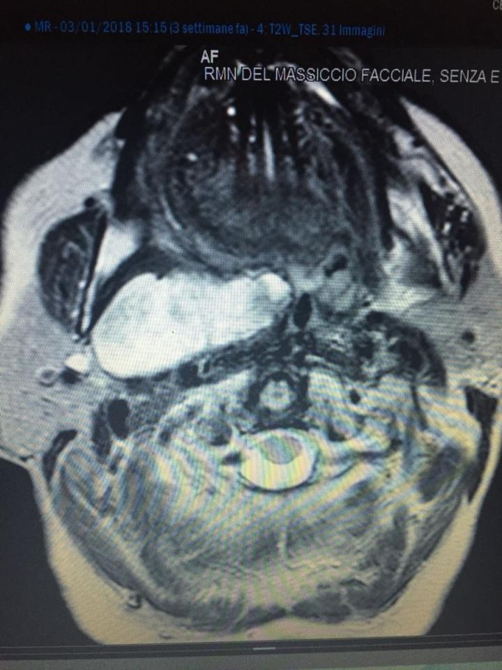 Operato con successo a Villa d'Agri un raro tumore neurologico del massiccio facciale ospedalesancarlo.it/node/6581