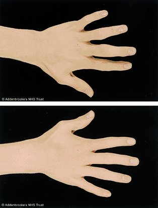 Pachydermodactyly in association with Asperger syndrome
onlinelibrary.wiley.com/doi/10.1046/j.…
Pachydermodactyly is a benign painless fibromatosis that principally affects the second to fourth digits of the hands bilaterally, typically occurring in otherwise well adolescent men.