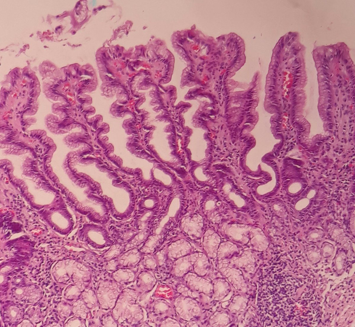 Foveolar Hyperplasia in a 5 yo boy with biliary reflux gastritis.