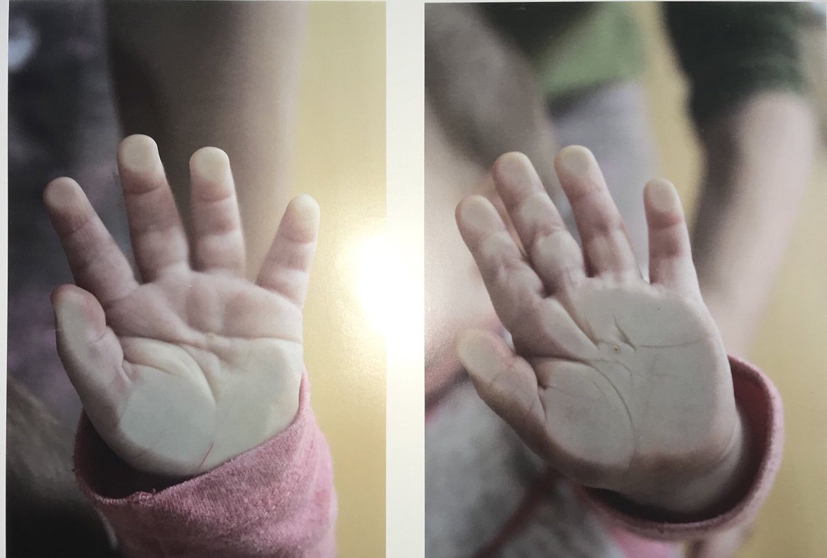 Toddler’s “curiosity” burn pattern. Natural touch (left) involves finger pads, palm and thumb. Central palm spared. Hand pressed onto surface doesn’t spare the central palm. Think safeguarding.