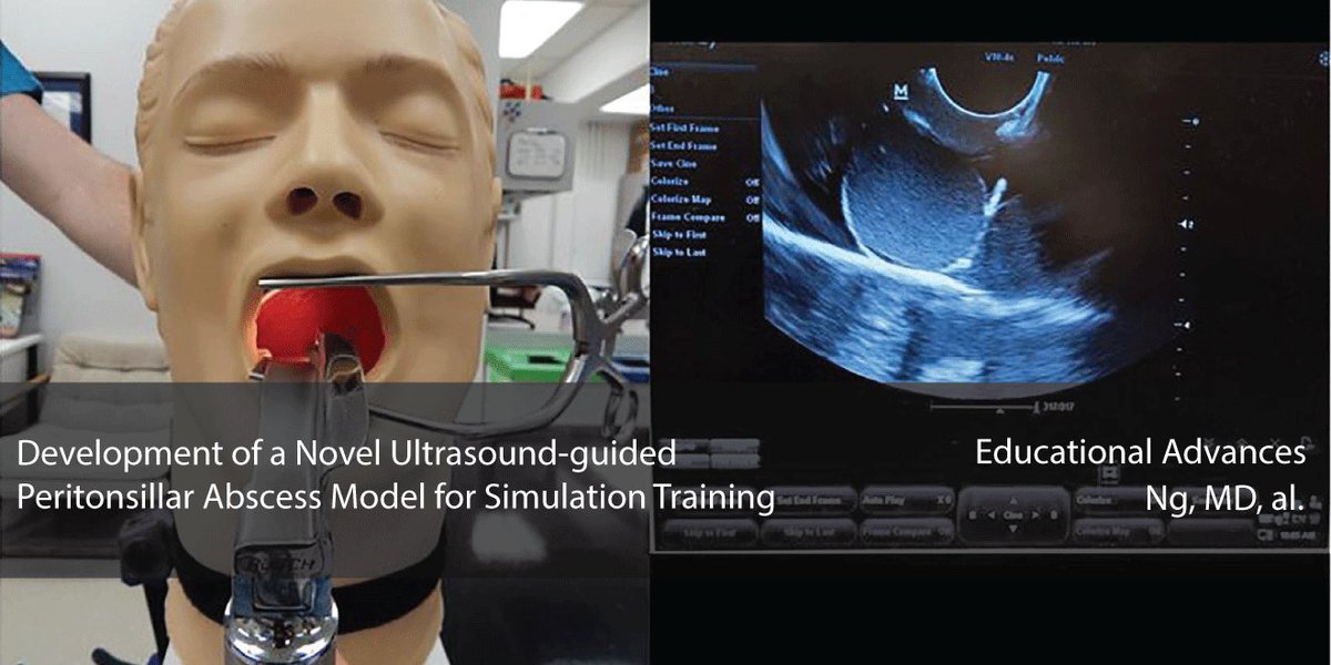 Development of a Novel #ultrasound guided Peritonsillar Abscess Model for #Simulation #POCUS #TuesdayThoughts #TuesdayMotivation #FOAMus Training Read Here: goo.gl/u1UveK
