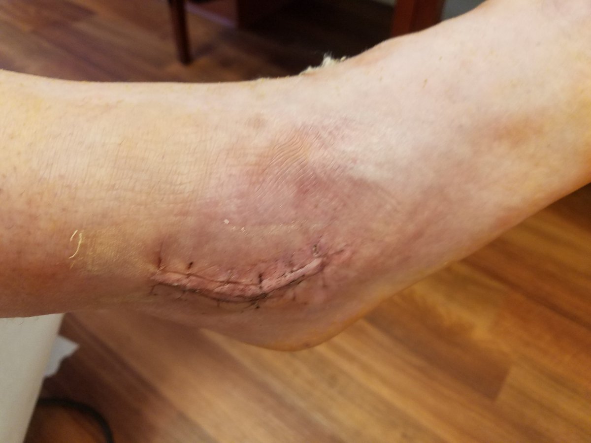 Road to recovery starts today😁