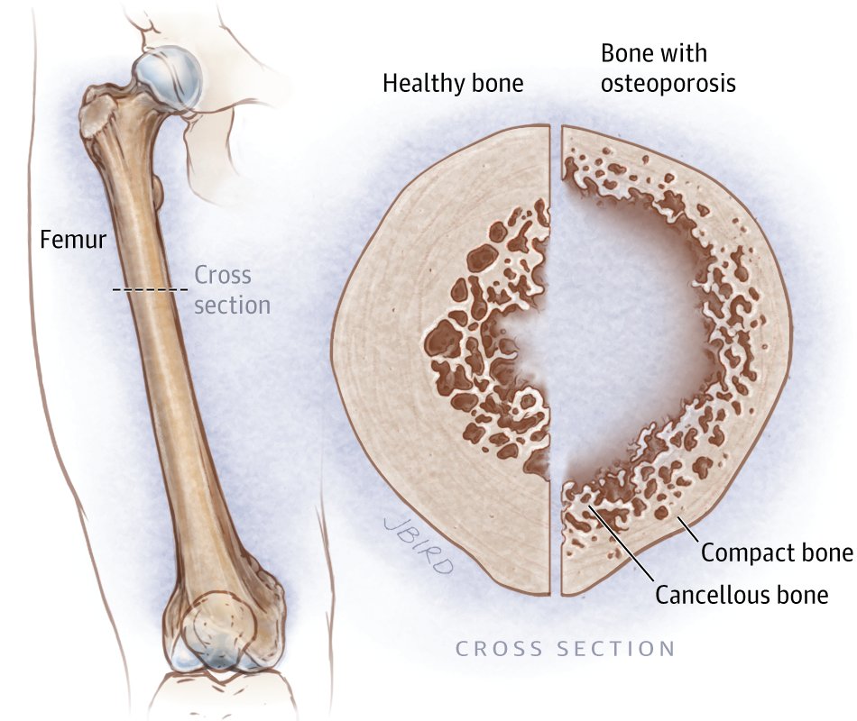 ammommx's tweet photo. Guideline on treatment of #Osteoporosis! https://t.co/KalCkOFnWJ https://t.co/4vs2ojmNS5
Source: @JAMA_current