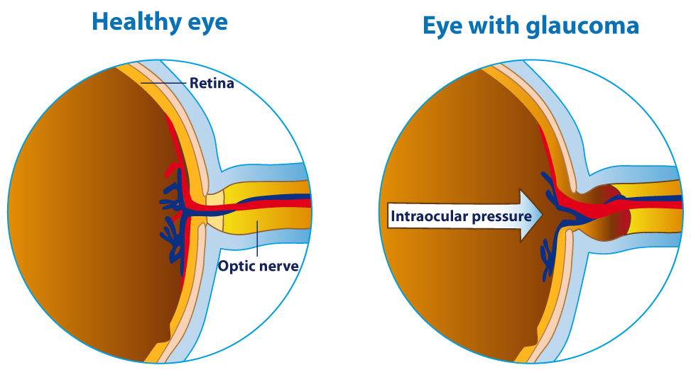 USCEye's tweet photo. Did you know that #openangle glaucoma is the most common type? #Glaucoma typically does not have any #symptoms until irreversible #visionloss begins to occur.
#worldglaucomaweek2018 #WGW2018 #usceye
https://t.co/6cw4KvC2OZ https://t.co/5Tos6fyS3o