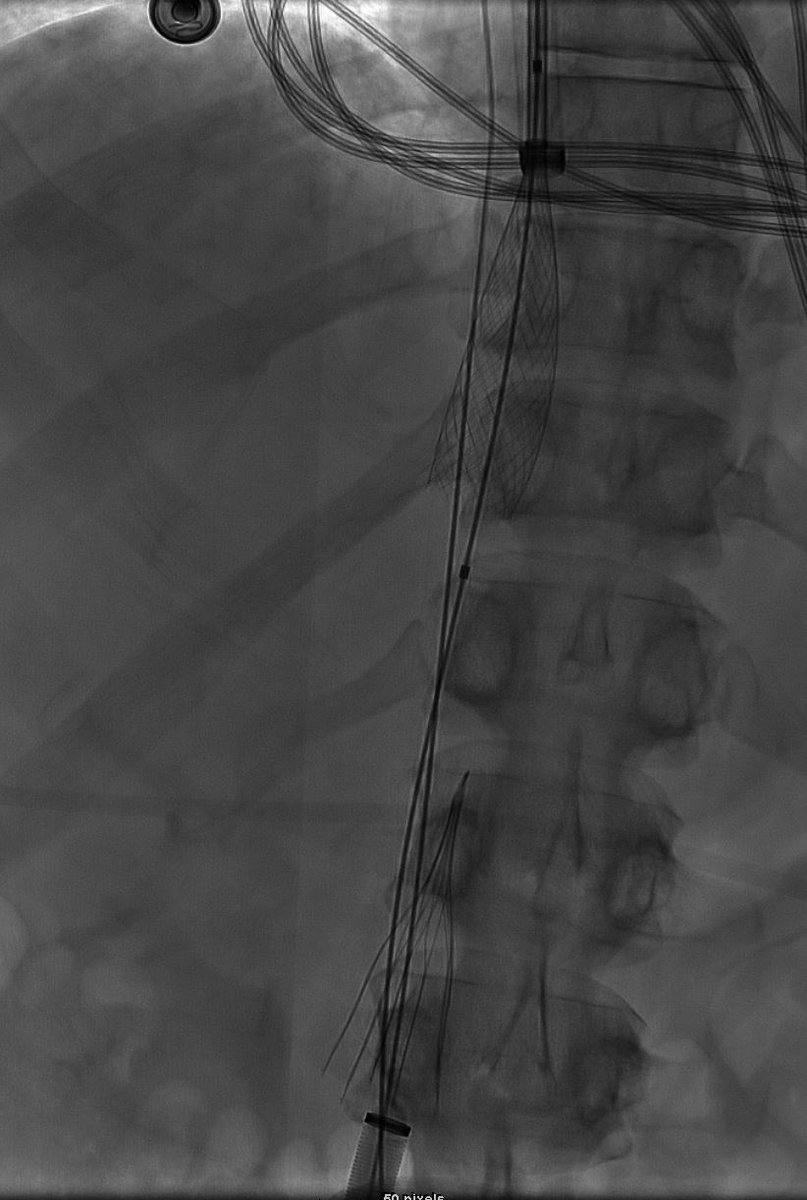 MountSinaiIR's tweet photo. @kush_r_desai @rkryu @MountSinaiNYC @ArgonMedical @bonesz @MarcinKolber @MCristMD @SIRspecialists Agree that the filter needs to come out. Used a half deployed @bostonsci Wallstent to capture potential embolic and grab the filter from the groin #transfemoral #graspers via @Medtronic Sentrant sheath https://t.co/TGkMxxXPxf