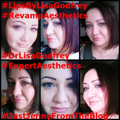 JustJennyEssex's tweet photo. #LipsByLisaGodfrey #DrLisaGodfrey #RevampAesthetics #ExpertAesthetis #JustJennyFromTheBlog #LipFillersUsingCannulaTechnique β€οΈπππ@lisaGod14359651 https://t.co/5AP0tT0Hdi
