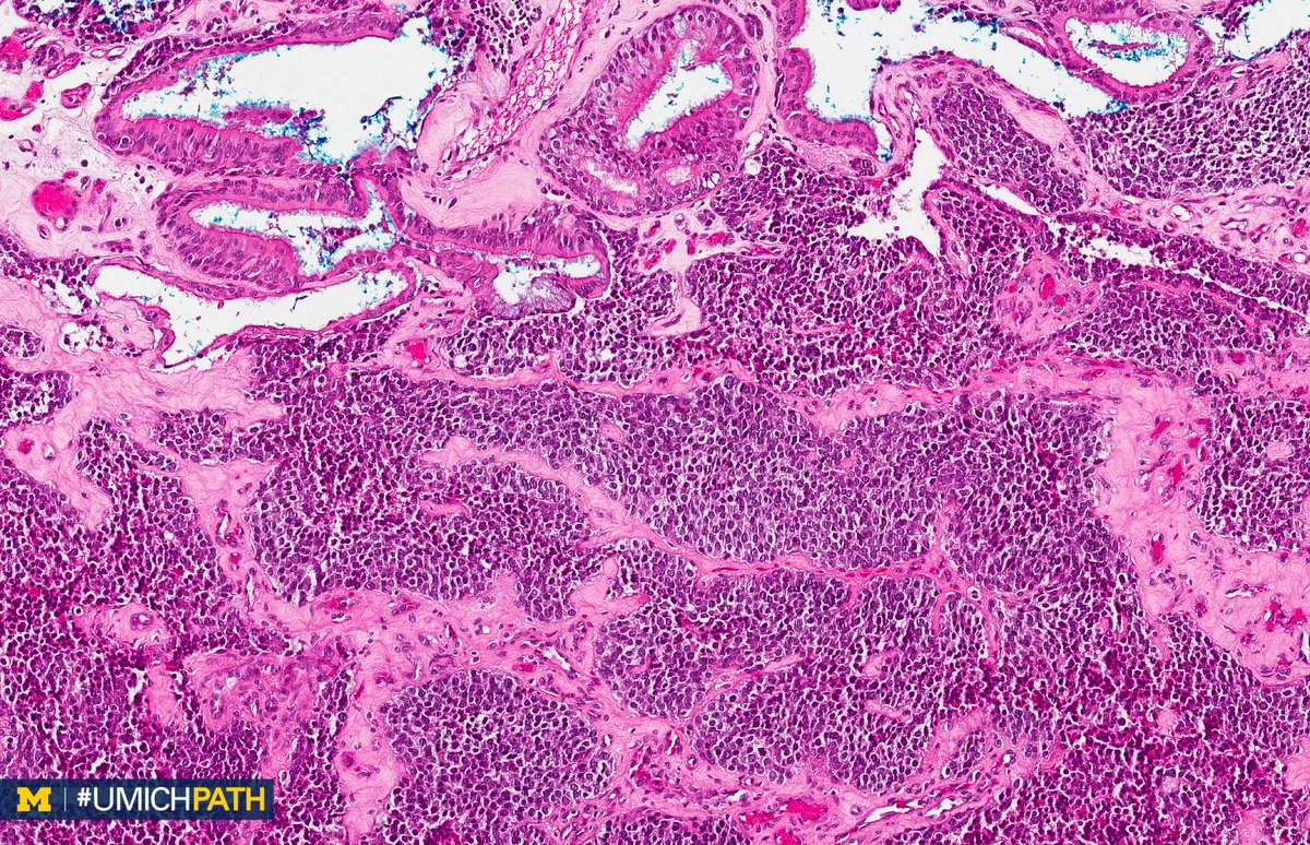 UMichPath's tweet photo. A: Olfactory neuroblastoma (esthesioneuroblastoma). Involves cribriform plate of ethmoid sinus. Histo: LOBULAR; small round blue cells 🔵 in fibrillary matrix. Pseudorosettes (Homer-Wright, 30%) &amp; rosettes (Flexner-Wintersteiner, 5%). IHC: ➕SYN/CGA; CK➖ #DailyDx #ENTPath https://t.co/Ea3XVW7fzO