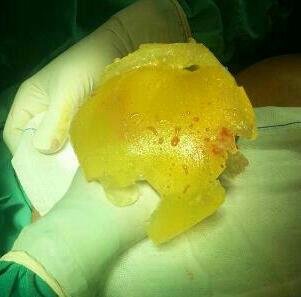 PIPActionA's tweet photo. REMINDER: 2012 Keogh on #PIPimplants 
“milky fluid” described by some surgeons on explant of PIP implants, consisted essentially of a suspension of silicones in water, rather than the product of some inflammatory reaction. (K9 pg7)

#FAKEconclusions #FAKEscience @Jeremy_Hunt https://t.co/OIcEyiqhwZ